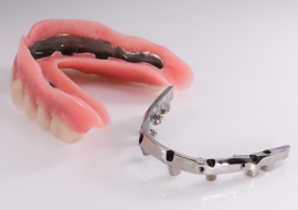 Implants_K-bar_and_overdenture