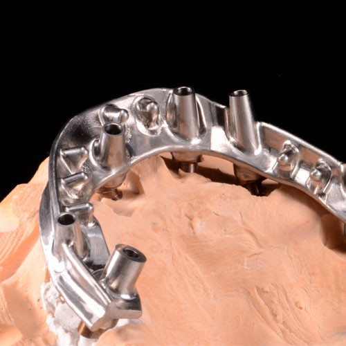 CAD/CAM Overdenture Bars and Frameworks